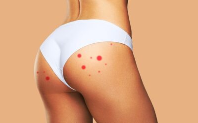 Butt Acne – how did I get pimples get there?